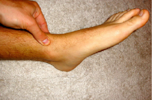 Leg of a person suffering from water retention